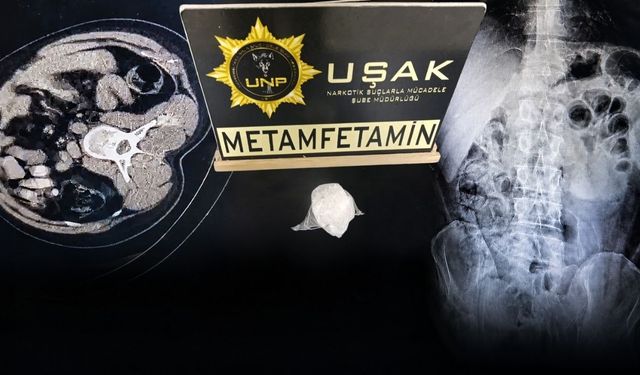 Zehir Taciri Yasaklı Maddeyi Midesinde Saklamış
